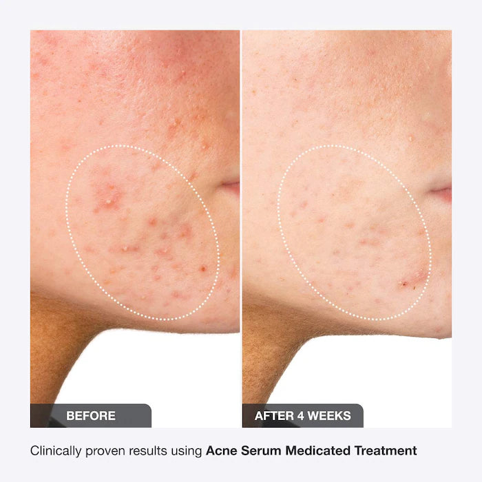 iNNBEAUTY PROJECT
Acne Serum Medicated Treatment for Acne & Blackheads