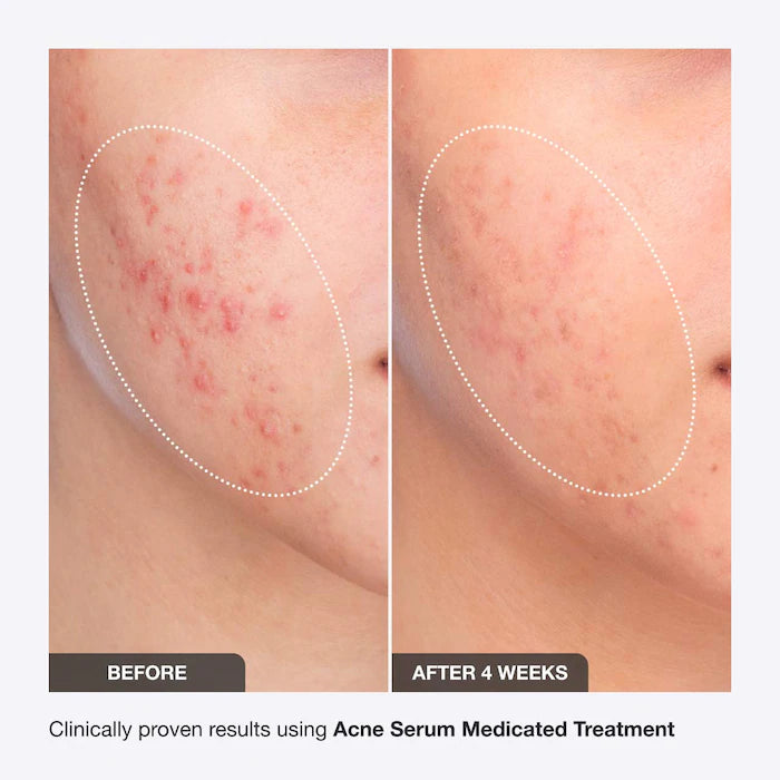 iNNBEAUTY PROJECT
Acne Serum Medicated Treatment for Acne & Blackheads